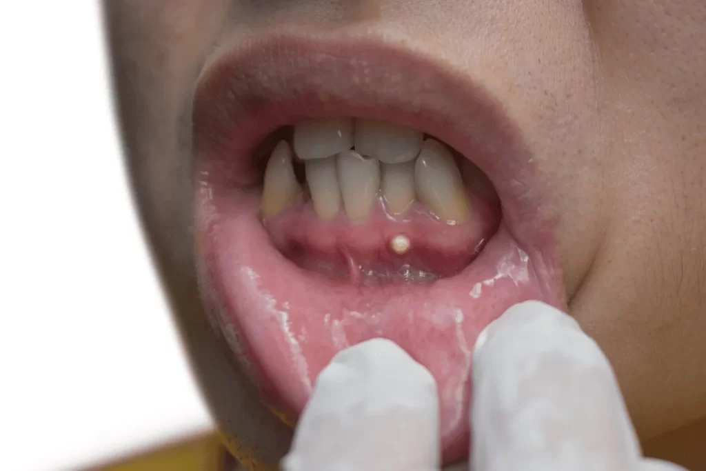 Dental Abscesses (1)