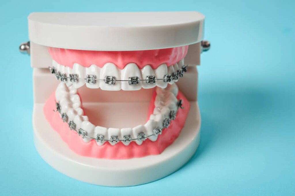 braces (1)