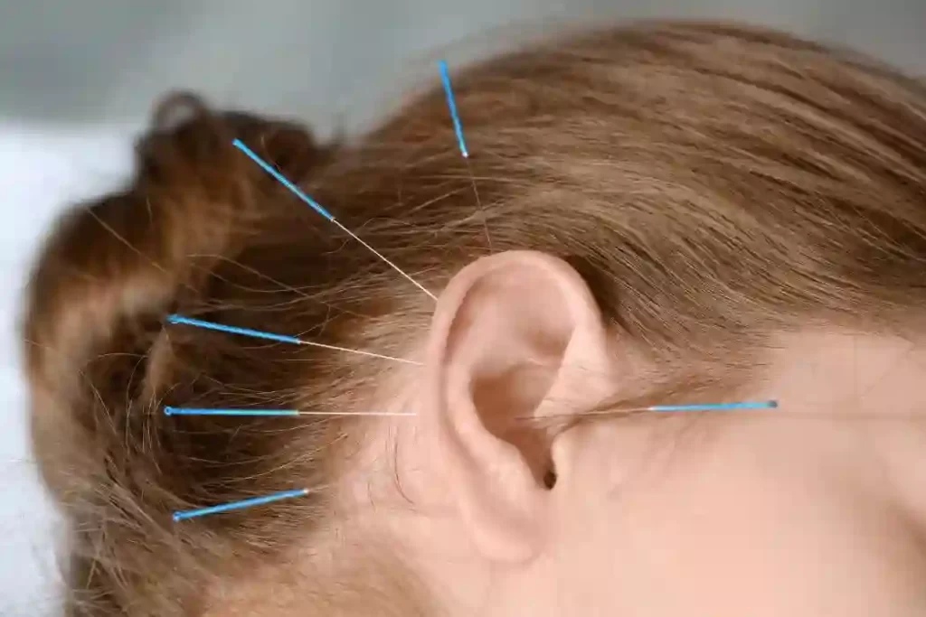Ear Acupuncture 1