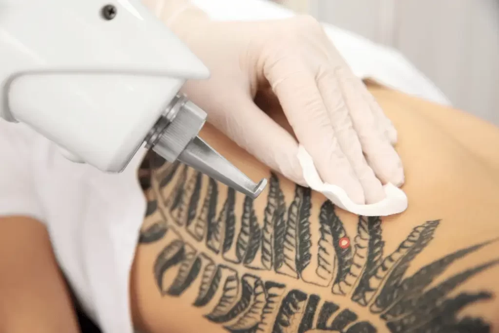 Laser Tattoo Removal 1