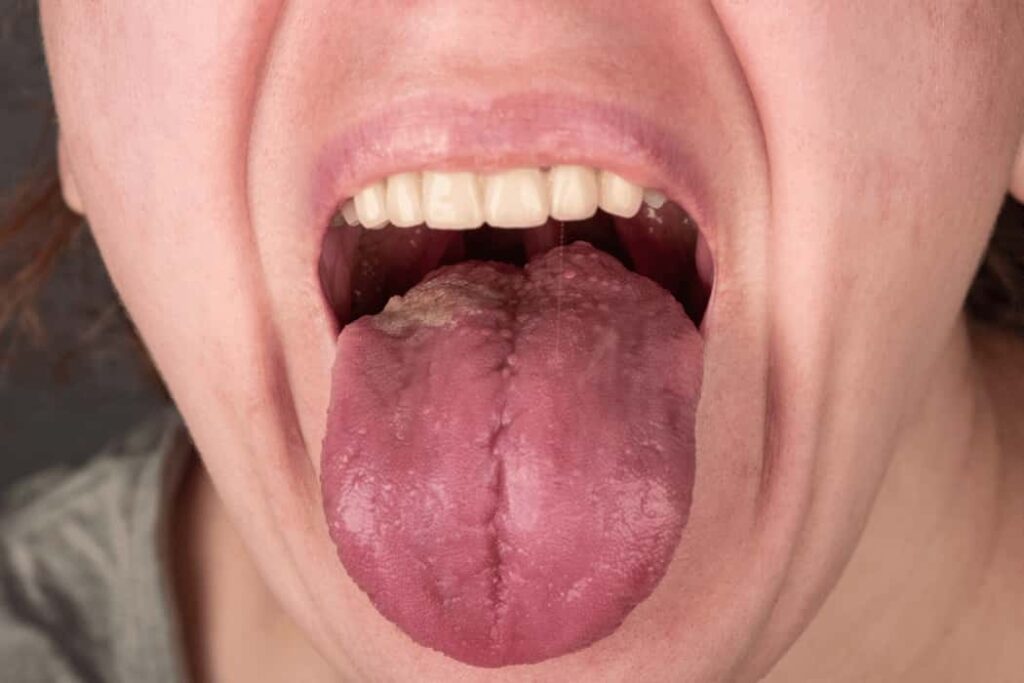 Tongue Bumps