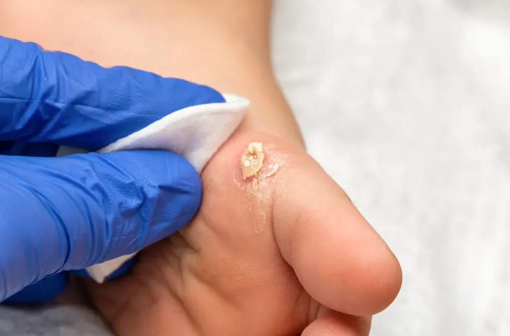 remove corns on feet overnight (1)