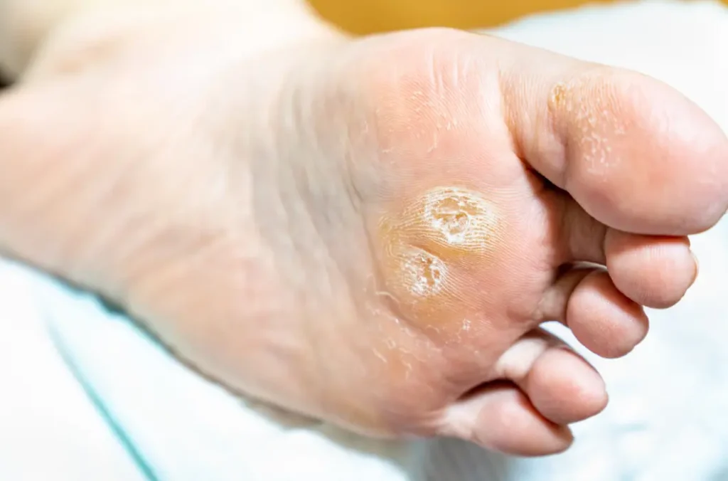 remove corns on feet overnight