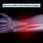 Hand Fracture Surgery