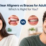 Clear Aligners vs Braces for Adults (1)