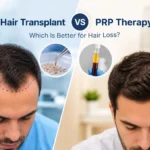 Hair Transplant vs PRP Therapy-1