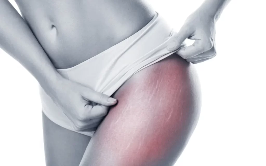 essential oils for stretch marks