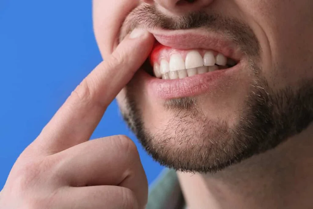 Hole in Gums (2)