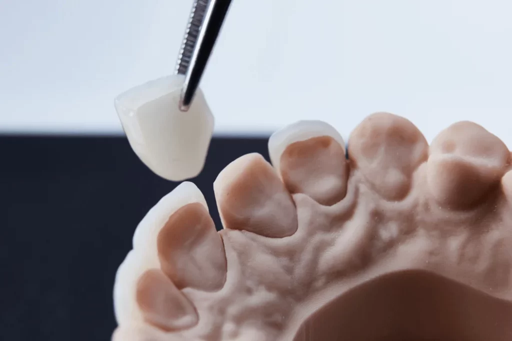 How Dental Erosion Threatens Your Smile Dental Erosion