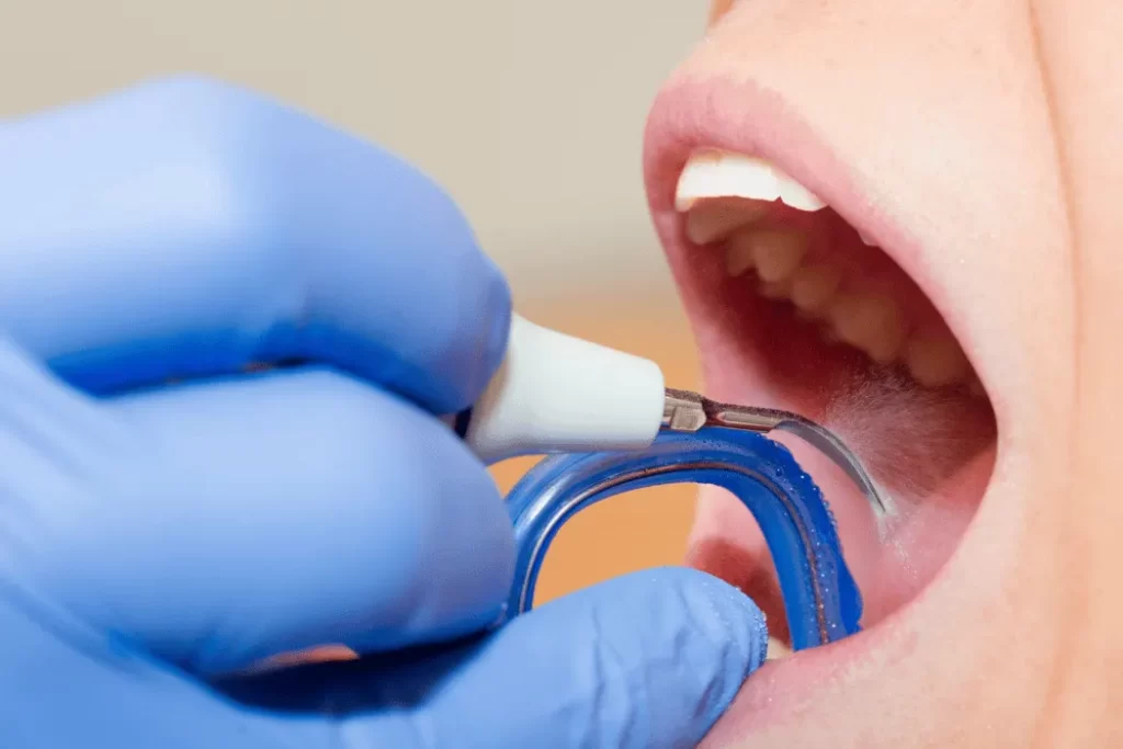 Dental Calculus