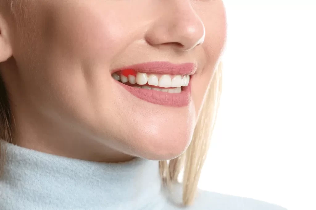Dental Abscesses