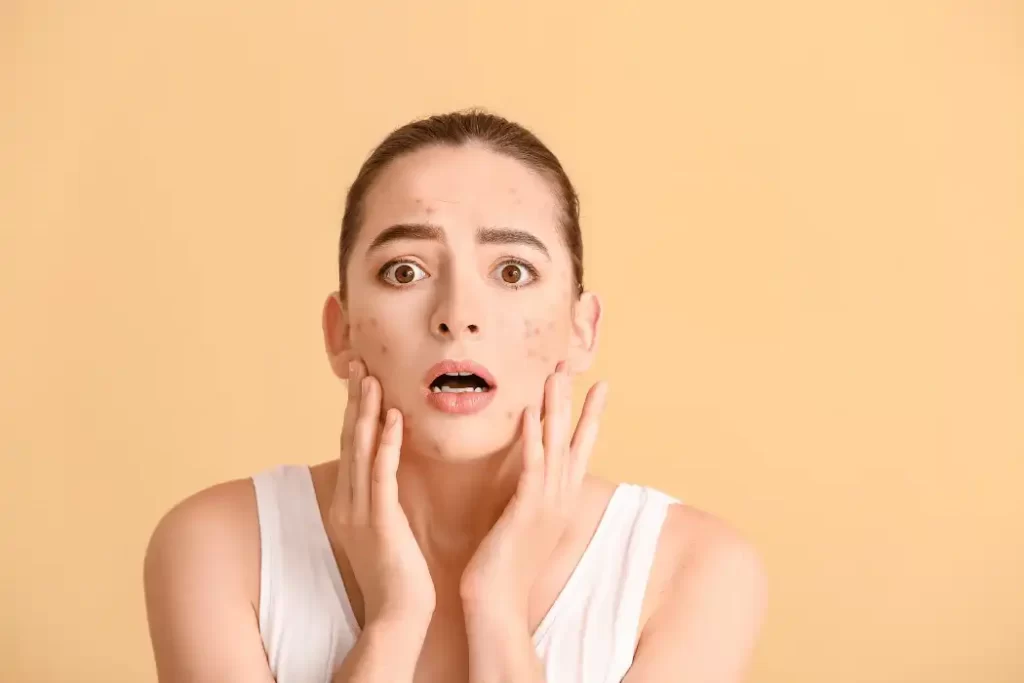acne around mouth 1