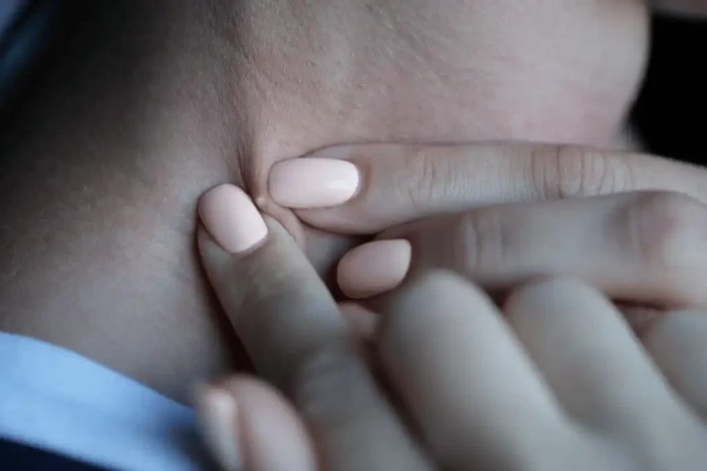 Say Goodbye to Pimple on Neck: Tips and Remedies pimple on neck 1