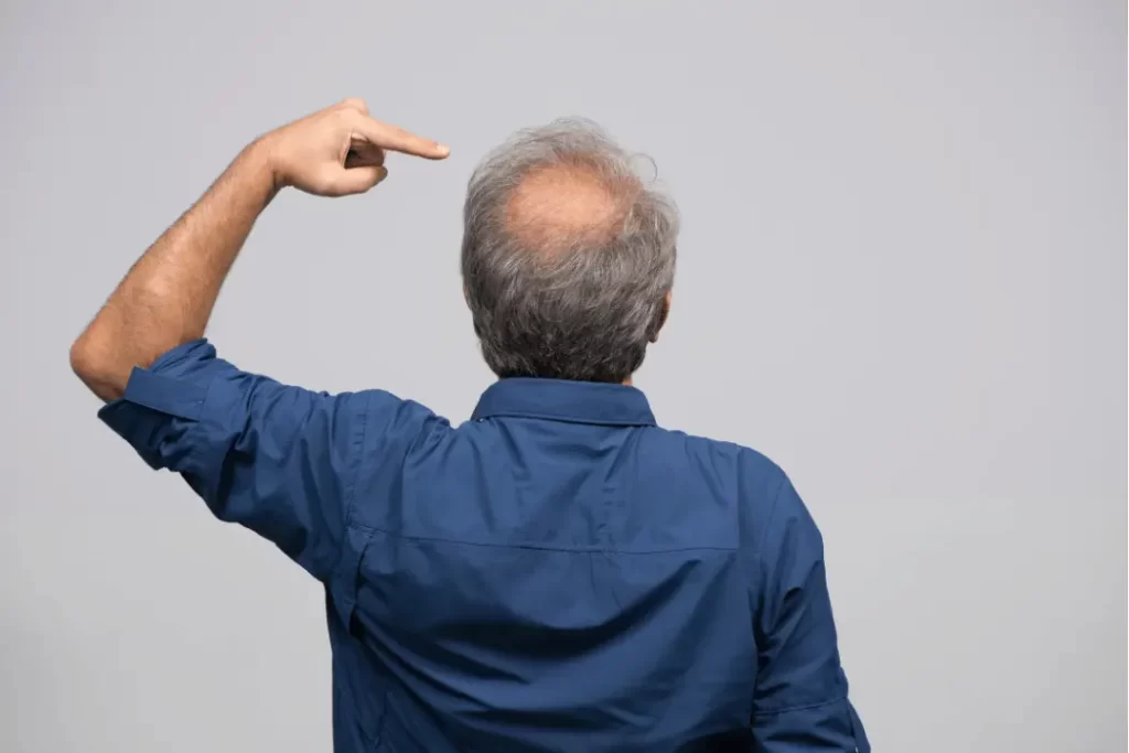 baldness cure 1