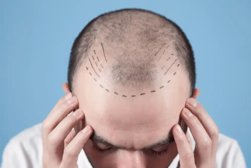 Hair Replacement 1