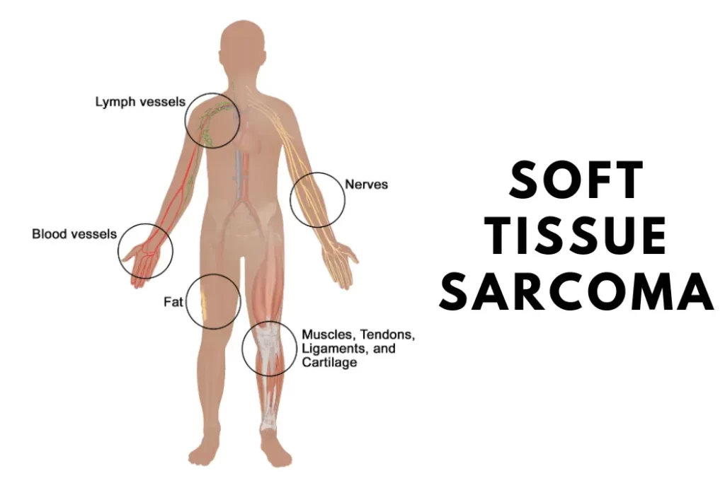 Soft Tissue Sarcoma