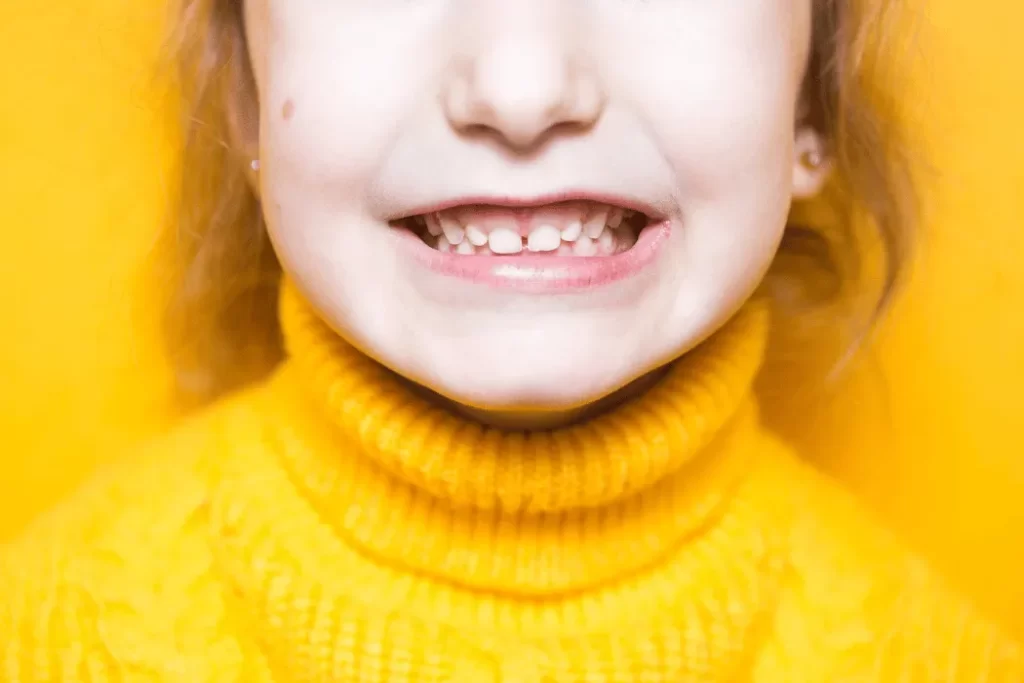 Malocclusion