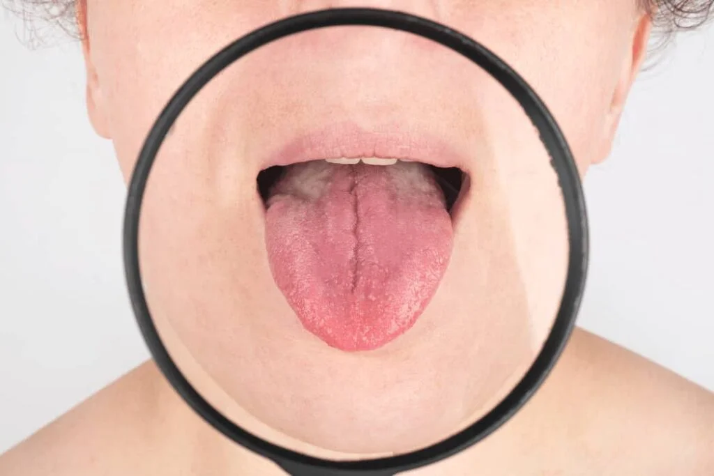 Tongue Bumps (1)
