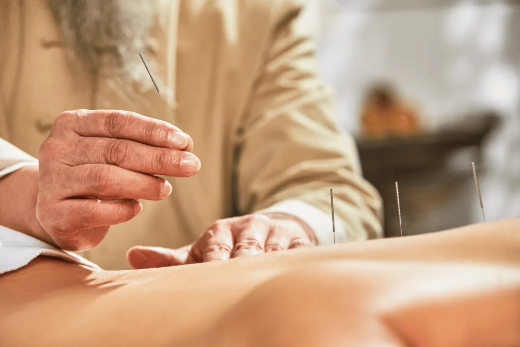 How Can Acupuncture Help in the Areas of Stress Reduction and Weight Loss? Acupuncture 3