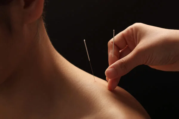 How Acupuncture Works: Benefits, Uses, and Potential Risks Acupuncture